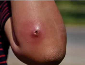 Skin Abscess