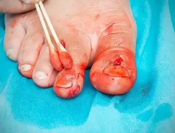 Paronychia Nail Infection