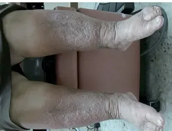 Lymphedema