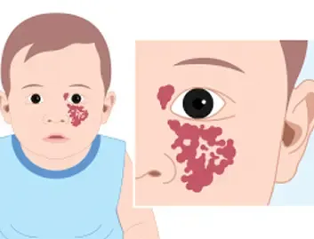 Congenital Vascular Malformations (CVM)