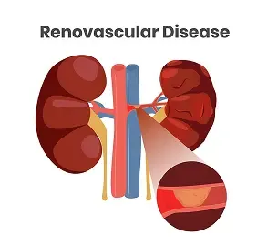 Renovascular Disease (RVD)