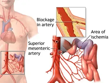 Mesenteric Artery Disease