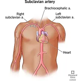 Subclavian Artery Disease