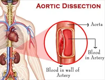 Aortic Dissection