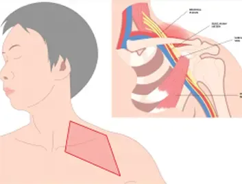 Thoracic Outlet Syndrome (TOS)
