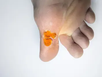 Diabetic Foot Ulcers (DFU)